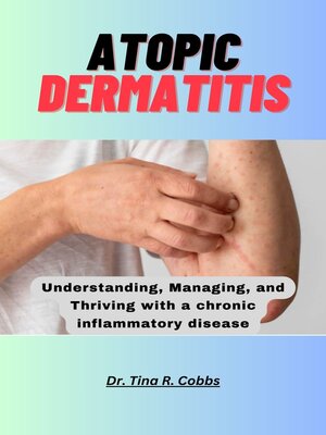 cover image of ATOPIC DERMATITIS